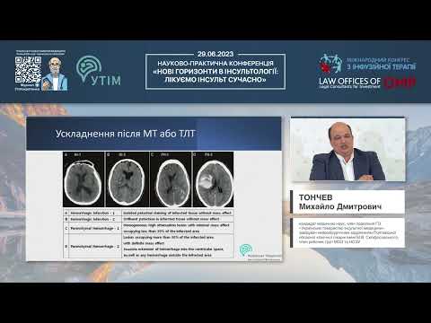 Видео: Хірургічне лікування ішемічного інсульту. Практичні поради нейрохірурга щодо лікування ГІІ