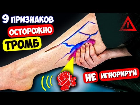 Видео: 9 Признаков что появился ТРОМБ! Тело предупреждает, НЕ Пропусти - ВЫЖИВЕШЬ