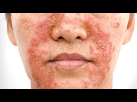 Видео: СЕБОРЕЙНЫЙ ДЕРМАТИТ: СОВРЕМЕННЫЙ ПОДХОД К ТЕРАПИИ (д.м.н. Баринова Анна Николаевна)