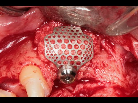 Видео: Имплантация, НКР во фронте верхней челюсти  Smart Builder