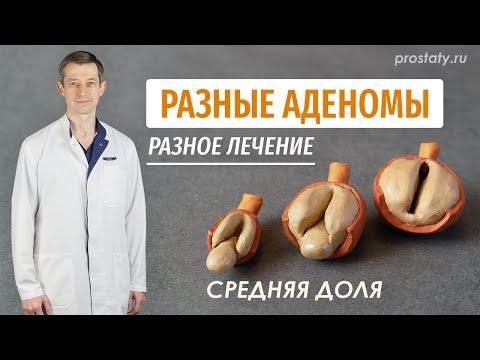 Видео: Конфигурации аденом простаты. Средняя доля. Разное лечение