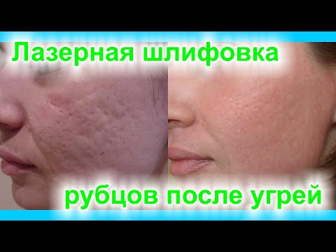 Видео: Лазерная шлифовка рубцов после угрей. Мифы о лазерных шлифовках постакне и реальные результаты.#5