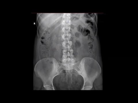 Видео: Укладка при внутривенной экскреторной урографии