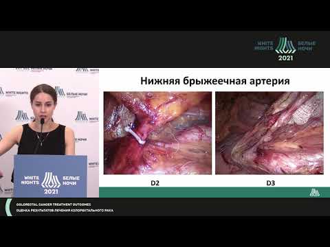 Видео: Анализ результатов лечения в рамках рандомиз. иссл-я D2 и D3 лимфодиссекции при раке ободочной кишки
