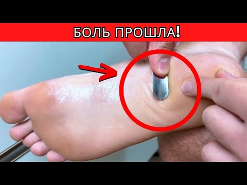 Видео: Подошвенный фасциит: домашнее лечение, которое действительно работает