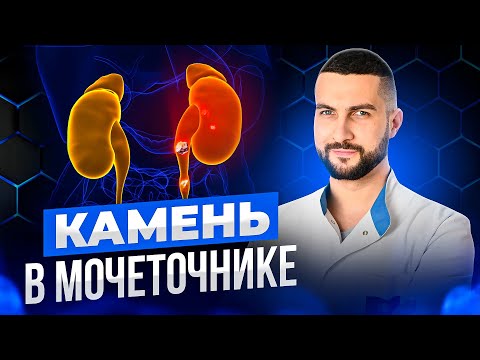 Видео: Что происходит после удаления камня мочеточника?