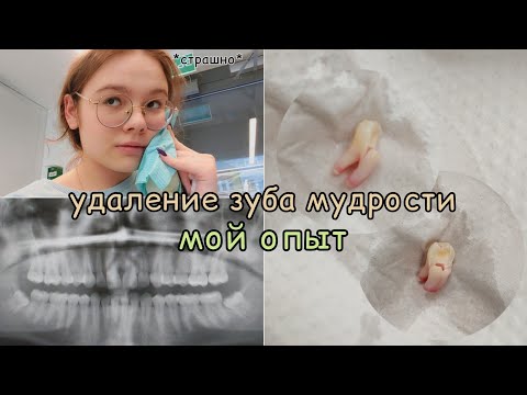 Видео: как я удаляла зуб мудрости мой опыт | моя история удаление зубов мудрости 🦷🤍