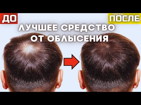 Видео: ГАЙД ПРО МИНОКСИДИЛ | РЕЗУЛЬТАТ, ПЕРЕРЫВЫ,  ПОБОЧКИ | МИНОКСИДИЛ ОТ ОБЛЫСЕНИЯ | МИНОКСИДИЛ ДЛЯ ВОЛОС