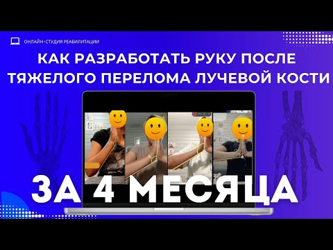 Видео: Как разработать руку после тяжелого перелома лучевой кости за 4 месяца