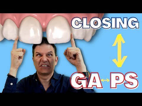 Видео: Как закрыть щели между зубами с помощью прозрачных капп