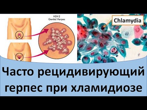 Видео: Часто рецидивирующий герпес при хламидиозе