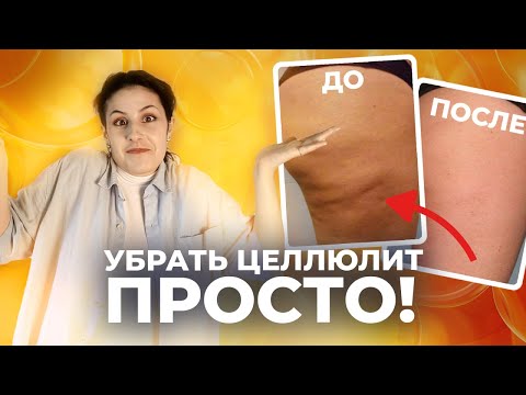 Видео: Как ИЗБАВИТЬСЯ ОТ ЦЕЛЛЮЛИТА? / как стать красивой