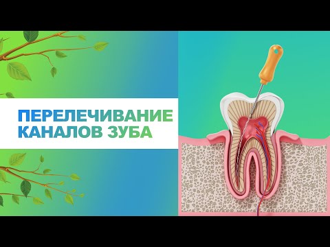 Видео: 🦷 Перелечивание каналов зуба