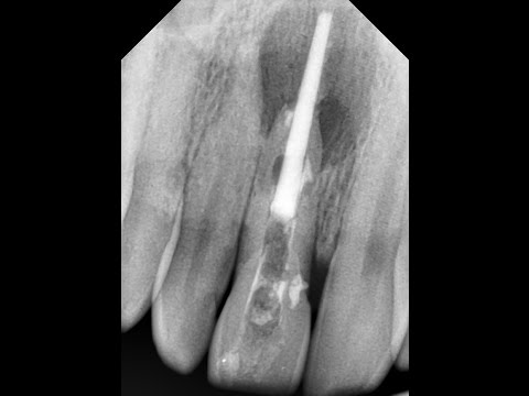 Видео: Почему гуттаперча выходит за верхушку? Часть 2