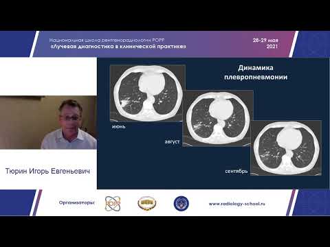 Видео: Пневмония и туберкулез  консолидация + очаги Тюрин И Е