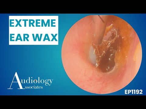 Видео: Экстремальное удаление ушной серы | Эндоскопическая микроаспирация - EP1192