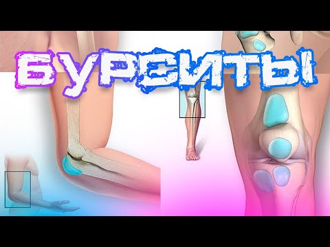 Видео: Бурситы: причины, симптомы и лечение | Экспертное мнение доктора Белозёровой М.А.