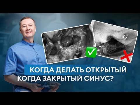 Видео: ОТКРЫТЫЙ или ЗАКРЫТЫЙ синус - лифт? КАКОЙ и КОГДА выполнять? Пошаговая инструкция