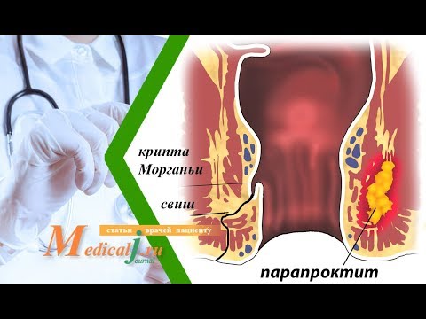 Видео: Парапроктит. Какие симптомы? Как лечить?