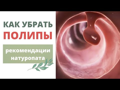 Видео: Почему появляются полипы? И как их убрать? | Николай Мавричев