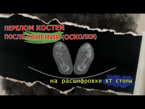 Видео: ОСКОЛКИ в стопе, ПЕРЕЛОМ ПЛЮСНЕВЫХ КОСТЕЙ после травмы, АРТРОЗ суставов на РАСШИФРОВКЕ КТ стопы