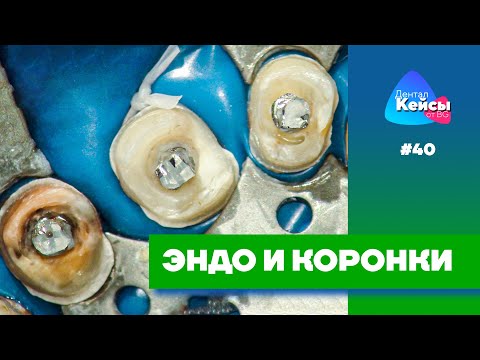 Видео: Эндо и коронки | Дентал Кейсы от BG #40