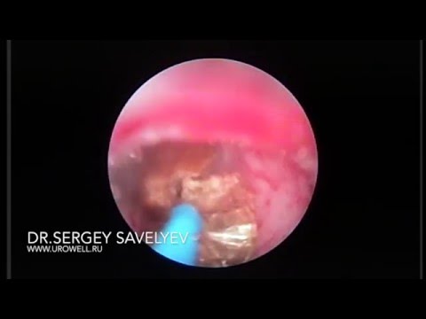 Видео: Контактная лазерная уретеролитотрипсия