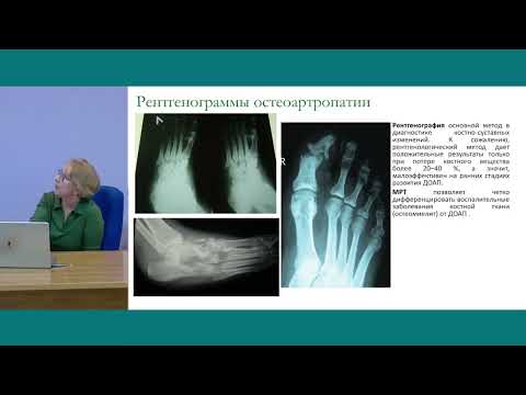 Видео: «Роль пациента и врача в профилактике синдрома диабетической стопы»