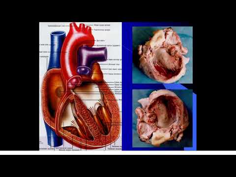 Видео: 9:50-11:20 Врожденные пороки сердца у детей