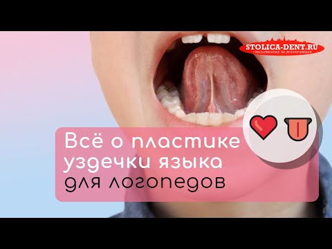 Видео: Когда нужна коррекция уздечки языка? ✔️ Запись вебинара «Логопеду – про уздечки»