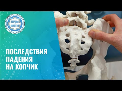 Видео: 👉 Последствия падения на копчик