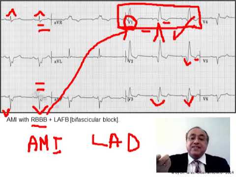 Видео: ЭКГ [3] Гемиблоки