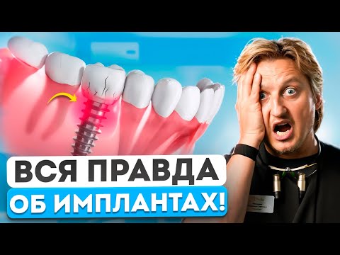 Видео: НЕ СТАВЬТЕ ИМПЛАНТЫ, пока не узнали эти 5 фактов! ПРАВДА, которую НЕ расскажут на консультации!