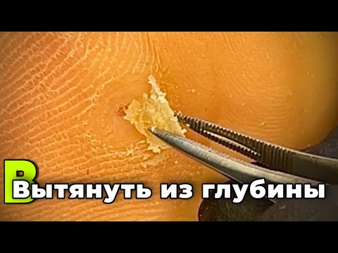 Видео: Глубокое разрастание спрессованной кожи. Мозоль под мизинцем 