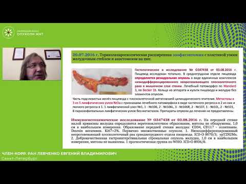 Видео: Местно-распространенный рак пищевода с изолированным метастазом в надключичный лимфоузел