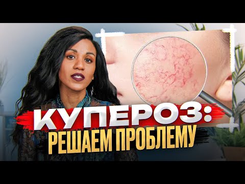 Видео: Купероз: решаем проблему // Сосуды на лице // Красное лицо // Телеангиэктазии