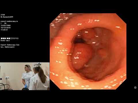 Видео: 03 Карпович ВВ живая демонстрация Трансназальная ЭГДС Полипы желудка