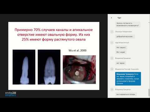 Видео: Endo.Education Вебинар Евгения Платонова "Инновации в обработке корневых каналов зуба с обтурацией"