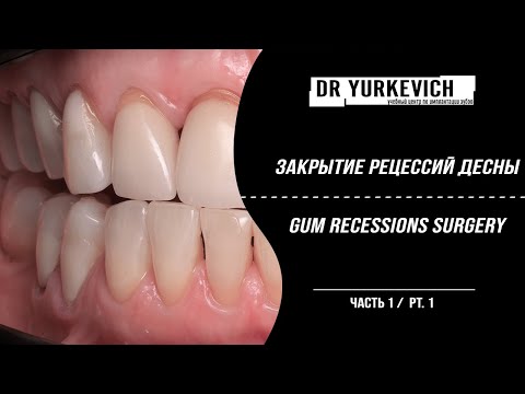 Видео: Закрытие рецессий десны на нижней челюсти ч. 1 / Lower jaw gum recessions coverage surgery pt.1