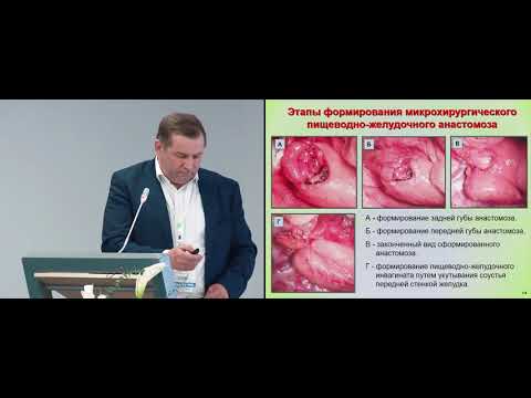Видео: Микрохирург.  пищеводно-желудочные анастомозы при резекции пищевода и кардии желудка. Самойлов П.В.