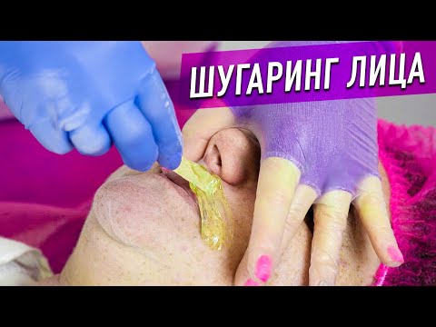 Видео: Удаление волос на нежной коже - Шугаринг Лица от Яны Осадчей