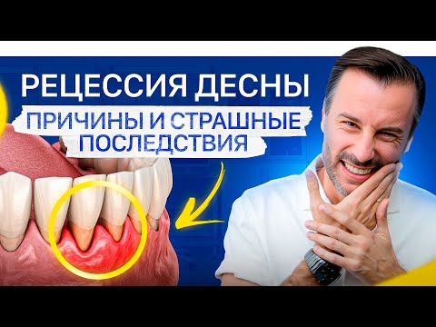 Видео: Неочевидная причина рецессии десны. Что делать, если опустилась десна?