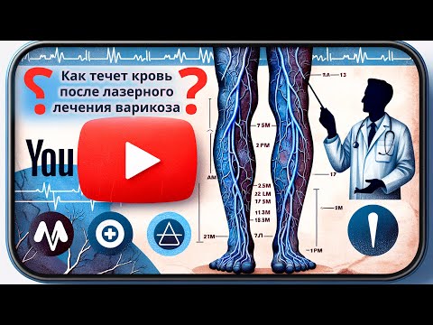 Видео: Куда же будет течь кровь после лазерного лечения варикоза