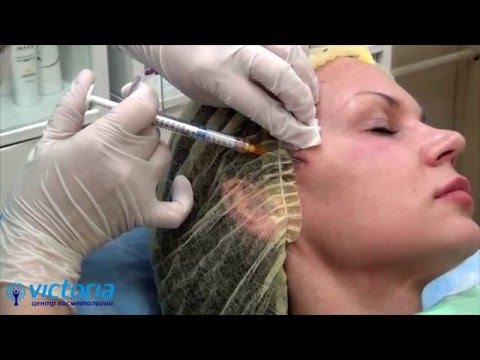 Видео: Контурная пластика препаратом Радиесс