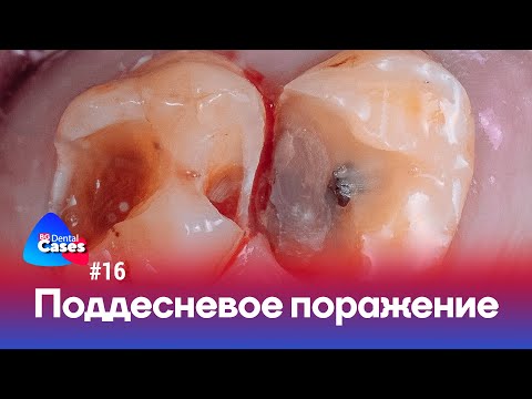 Видео: Поддесневое поражение | Дентал Кейсы BG №16
