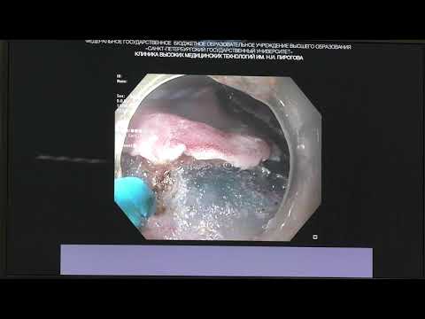 Видео: 26 Мальков ВА ESD в желудке Технические аспекты и безопасность