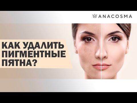 Видео: ЭТО ВАЖНО ЗНАТЬ ❗️ УДАЛЕНИЕ ПИГМЕНТНЫХ ПЯТЕН 🔥 ANACOSMA