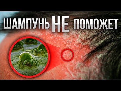 Видео: ЖИРНАЯ СЕБОРЕЯ КОЖИ ГОЛОВЫ: причины и лечение за 5 шагов