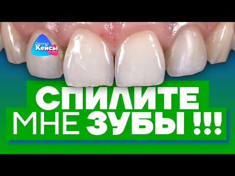 Видео: Спилите мне зубы | Дентал Кейсы от BG #32