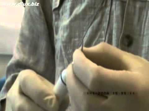 Видео: Ультразвуковой скалер в стоматологии.Часть №2